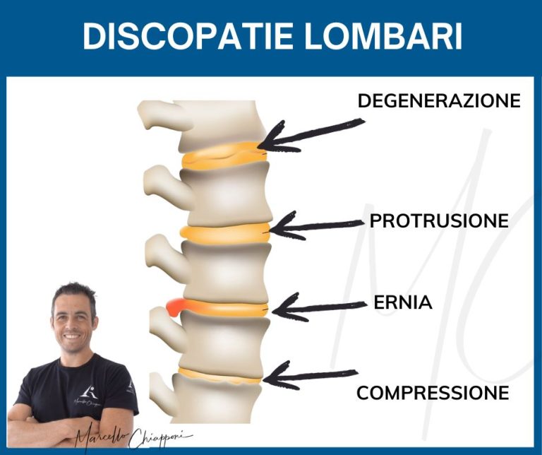 Discopatia O Protrusione L5 S1 Sintomi Ed Esercizi