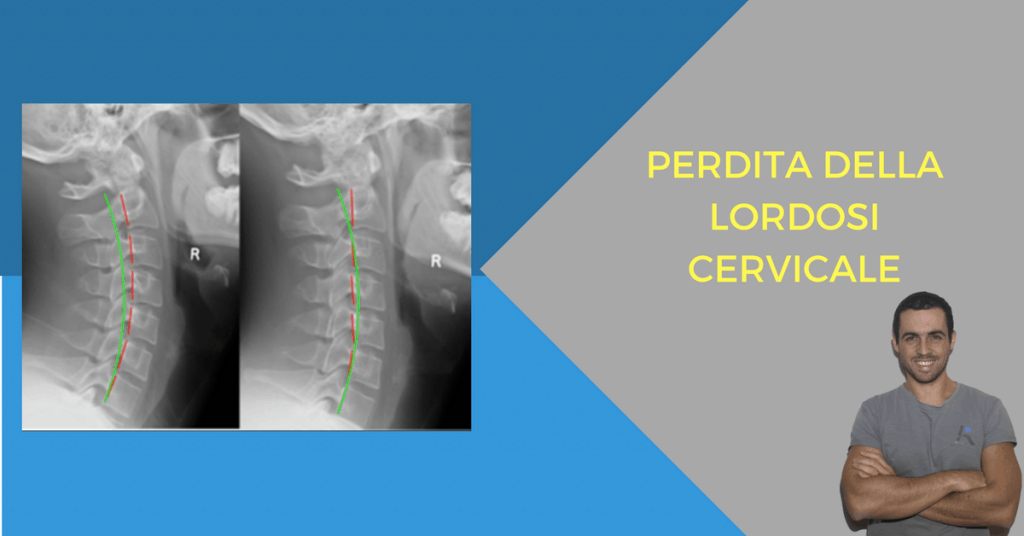 Curare la perdita della fisiologica lordosi cervicale - L'Altra